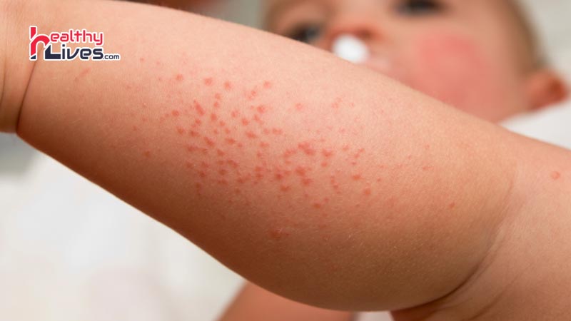 Common-food-allergies-associated-with-eczema-
