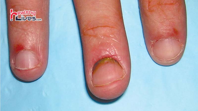 Paronychia--Nail-Infection--Natural-Treatment