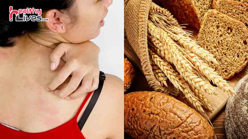 Gluten-Intolerance-Signs-and-Symptoms