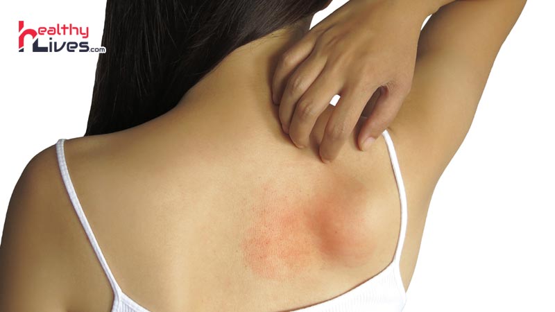 How-to-Get-Rid-of-a-Rash