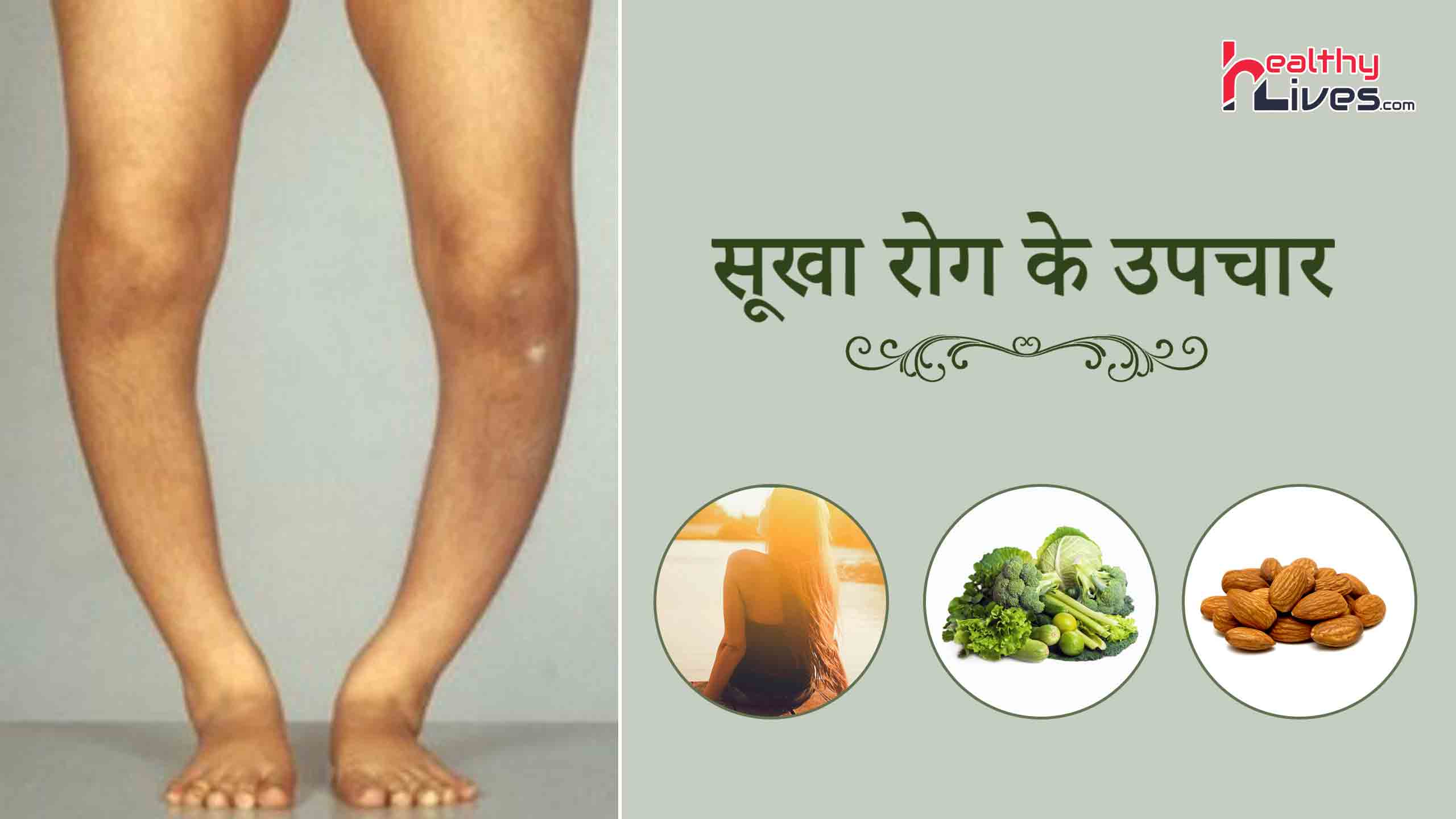 Rickets Treatment in Hindi: जानिए सूखा रोग के आसान घरेलू उपचार