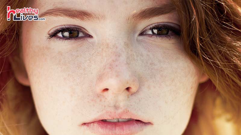 How-to-Get-Rid-of-Freckles-Naturally