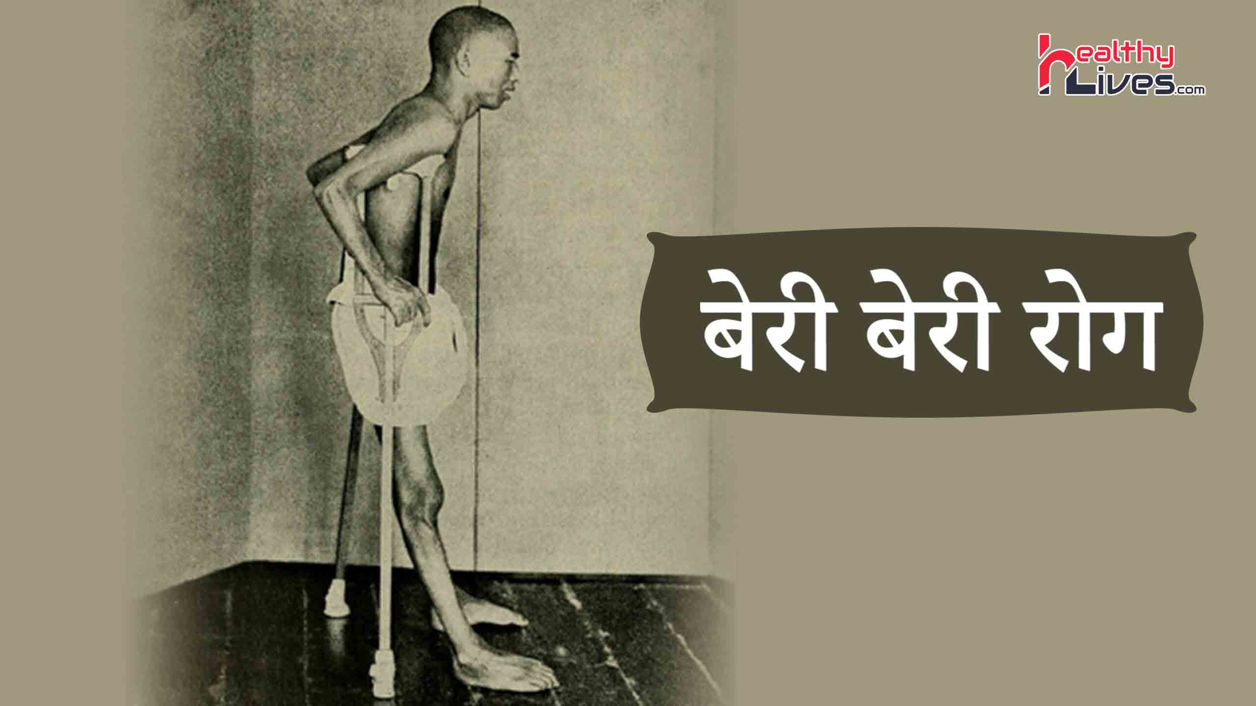 Beriberi Disease in Hindi: बेरी-बेरी रोग से जुड़ी उपयोगी जानकारियां