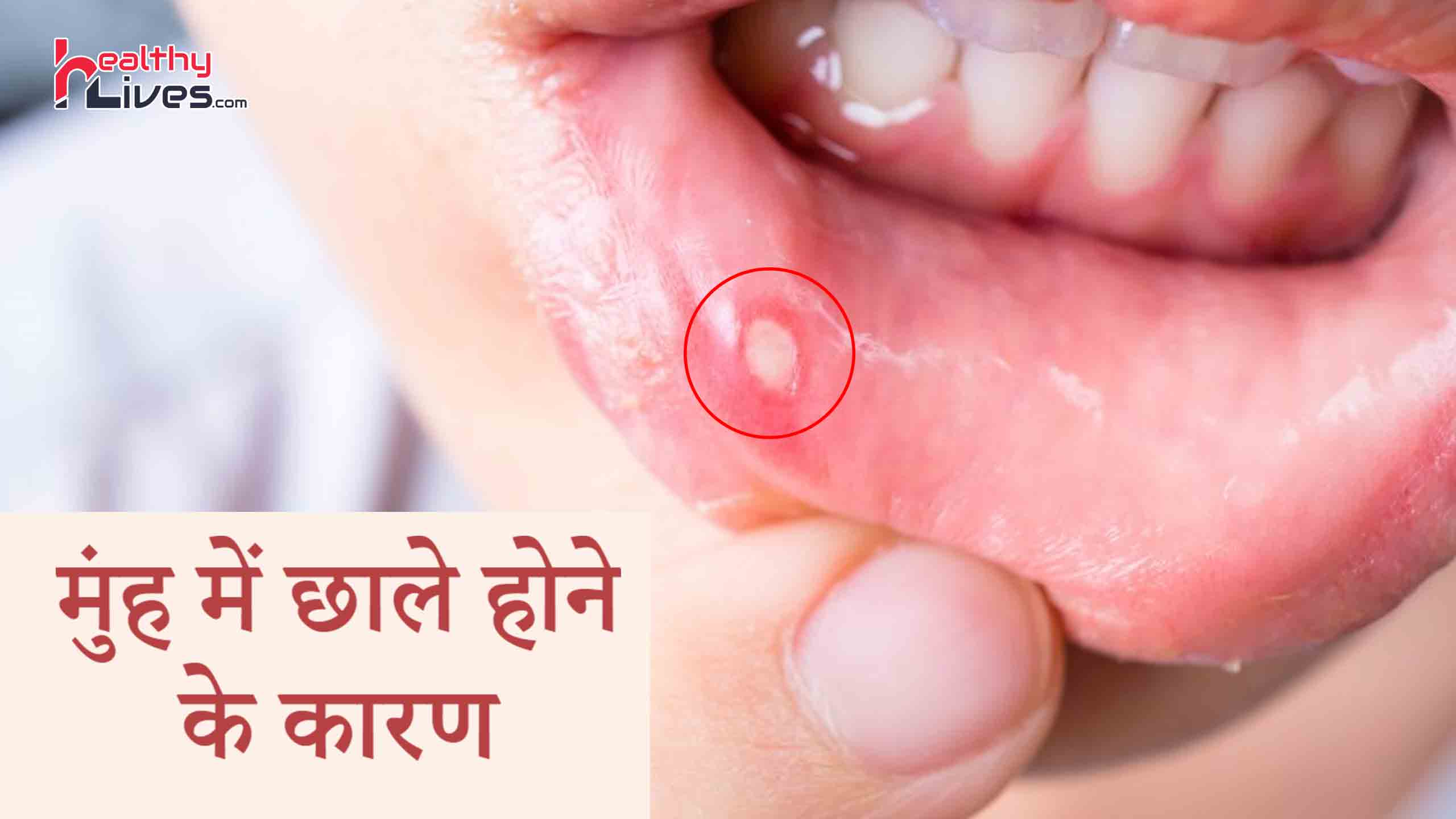 Mouth Ulcer Causes: इन कारणों से होते है मुंह में छाले