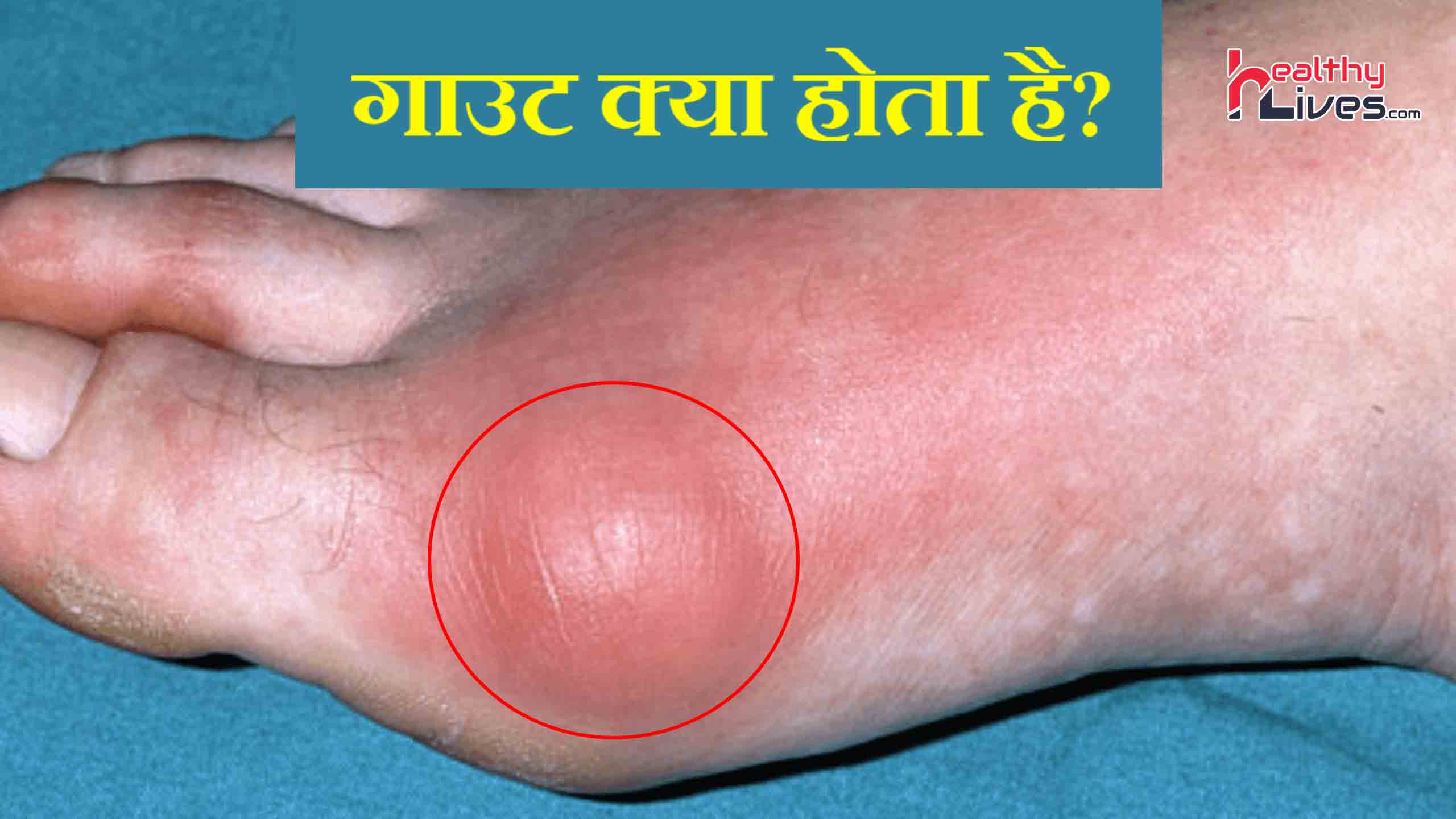 What is Gout: पैर के जोड़ो में दर्द का होना बन सकता है गाउट का कारण