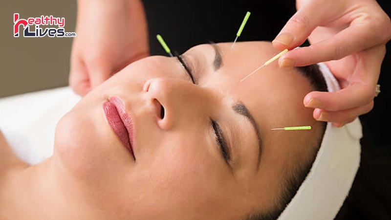 Acupuncture-for-Headaches