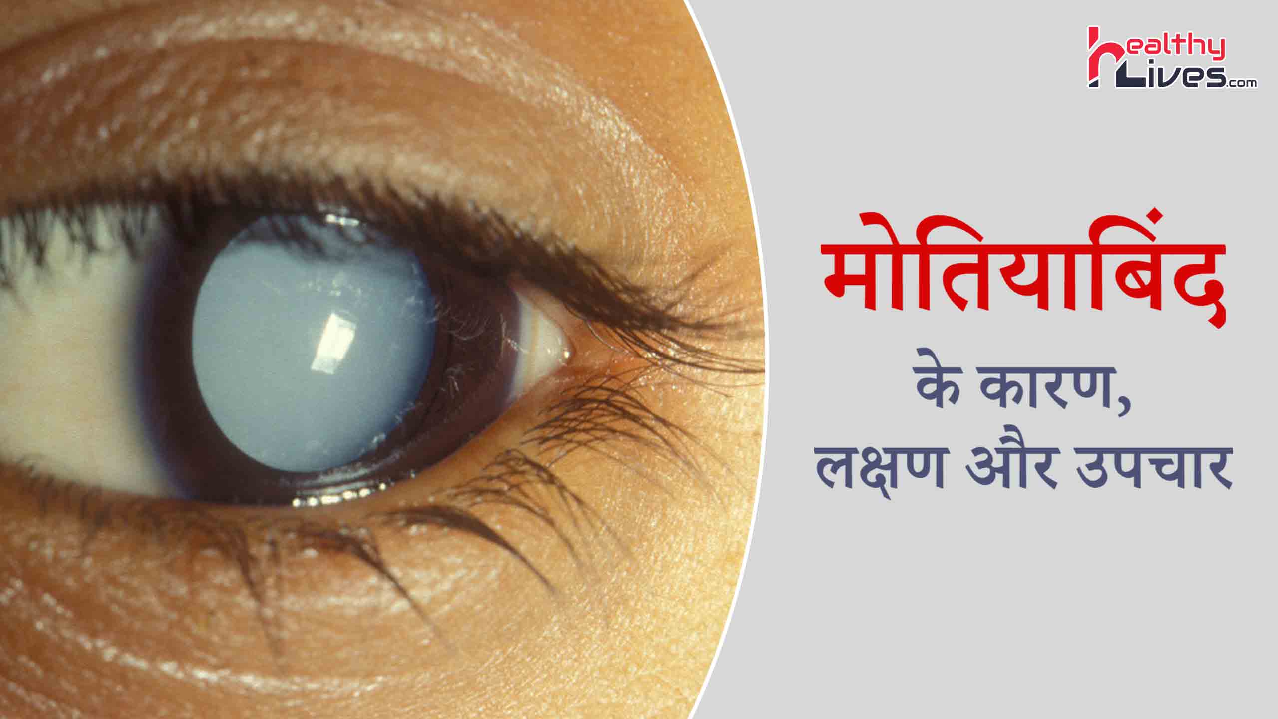 Cataract in Hindi: इन उपायों से रखे आँखों को स्वस्थ