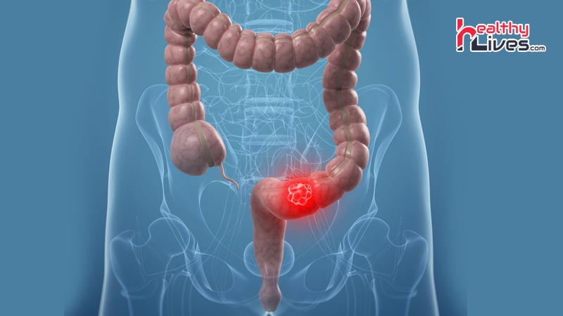 Colorectal-Cancer-in-Hindi