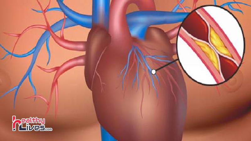 Coronary-Artery-Disease-in-Hindi