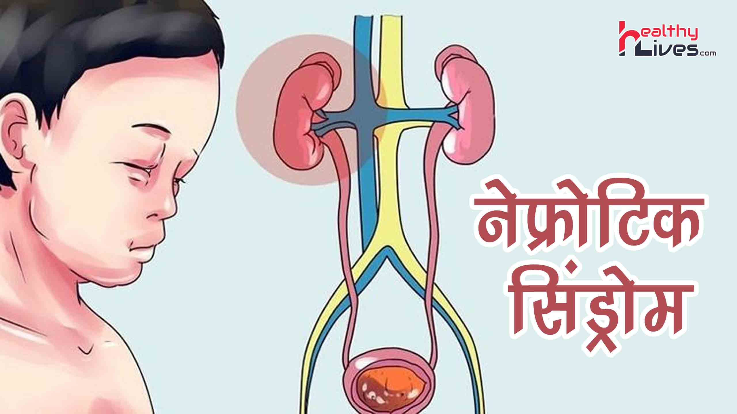 Nephrotic Syndrome in Hindi: कैसे पाएं नेफ्रोटिक सिन्ड्रोम से छुटकारा