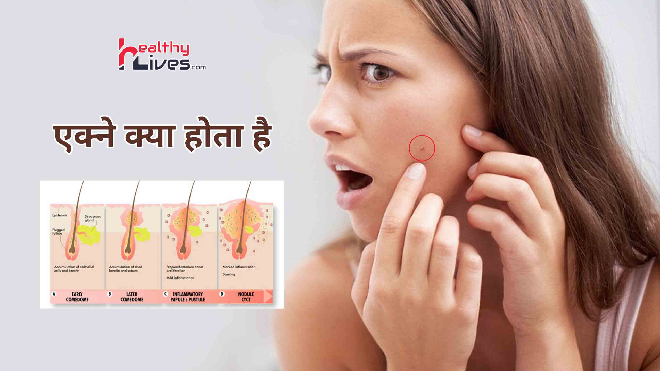 Acne Kya Hota Hai: एक्ने क्या है, जाने इस समस्या की सम्पूर्ण जानकारी