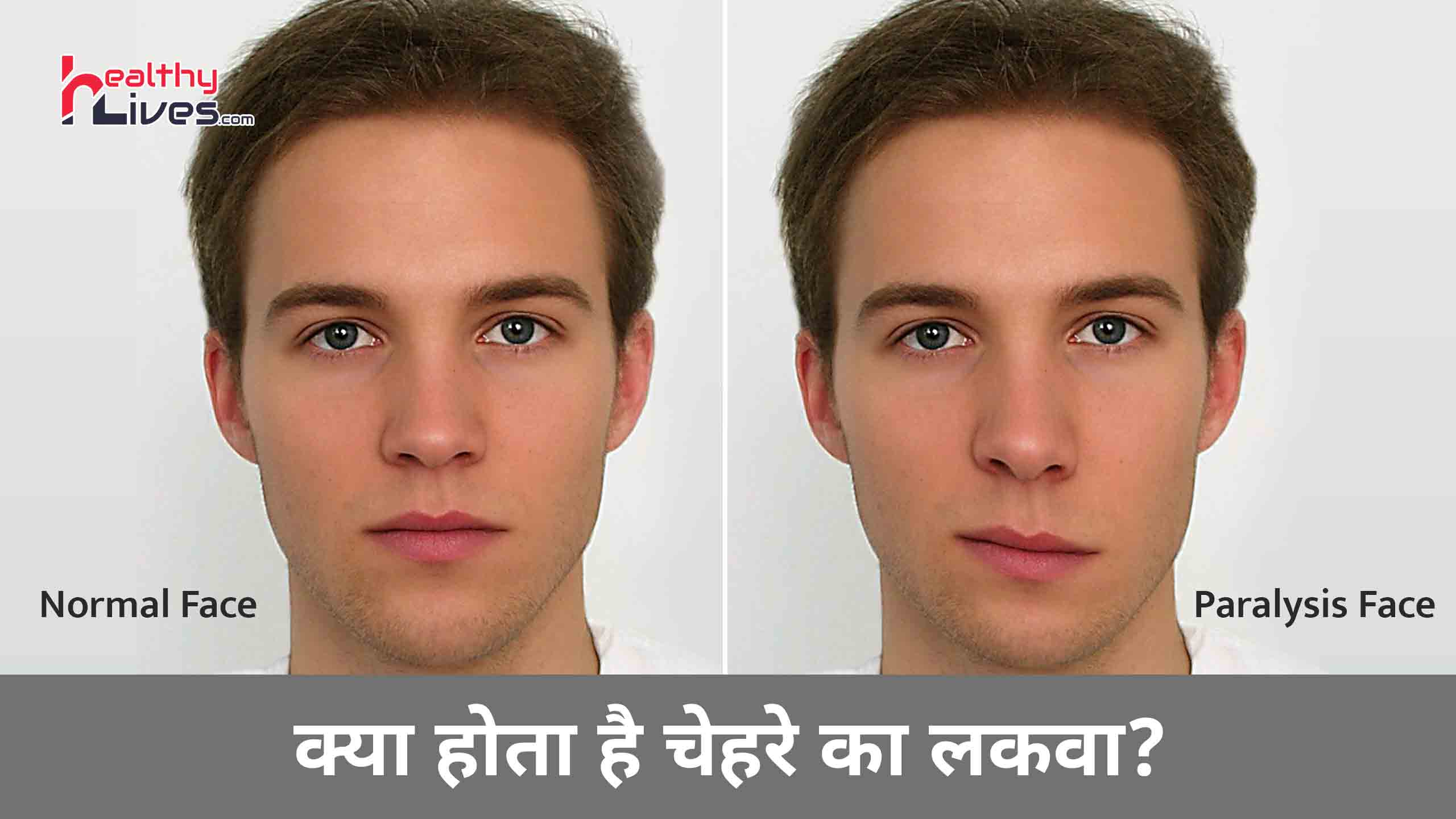 Facial Palsy in Hindi: कैसे होता है चेहरे का लकवा और क्या हैं इसके उपचार