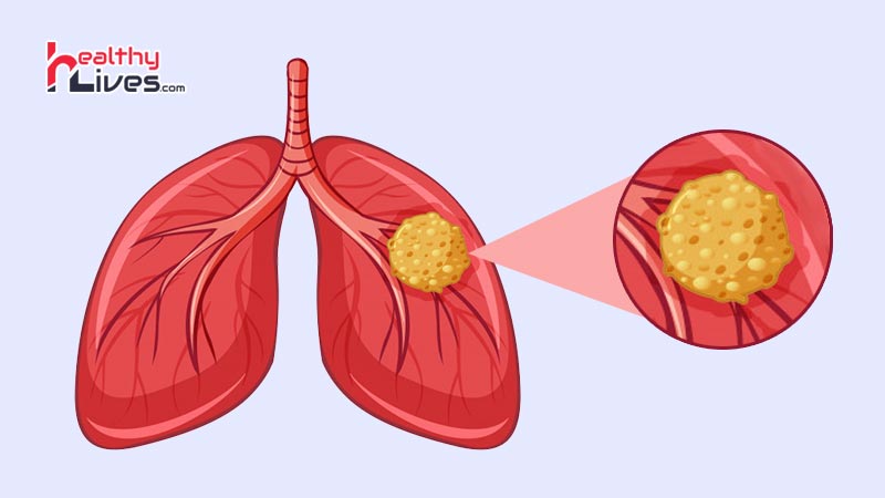 Lung-Cancer-Symptoms-in-Hindi