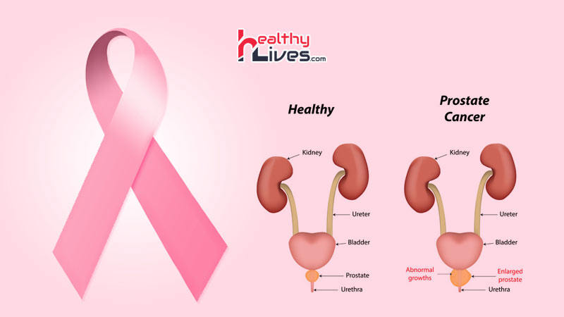 Prostate-Cancer-in-Hindi