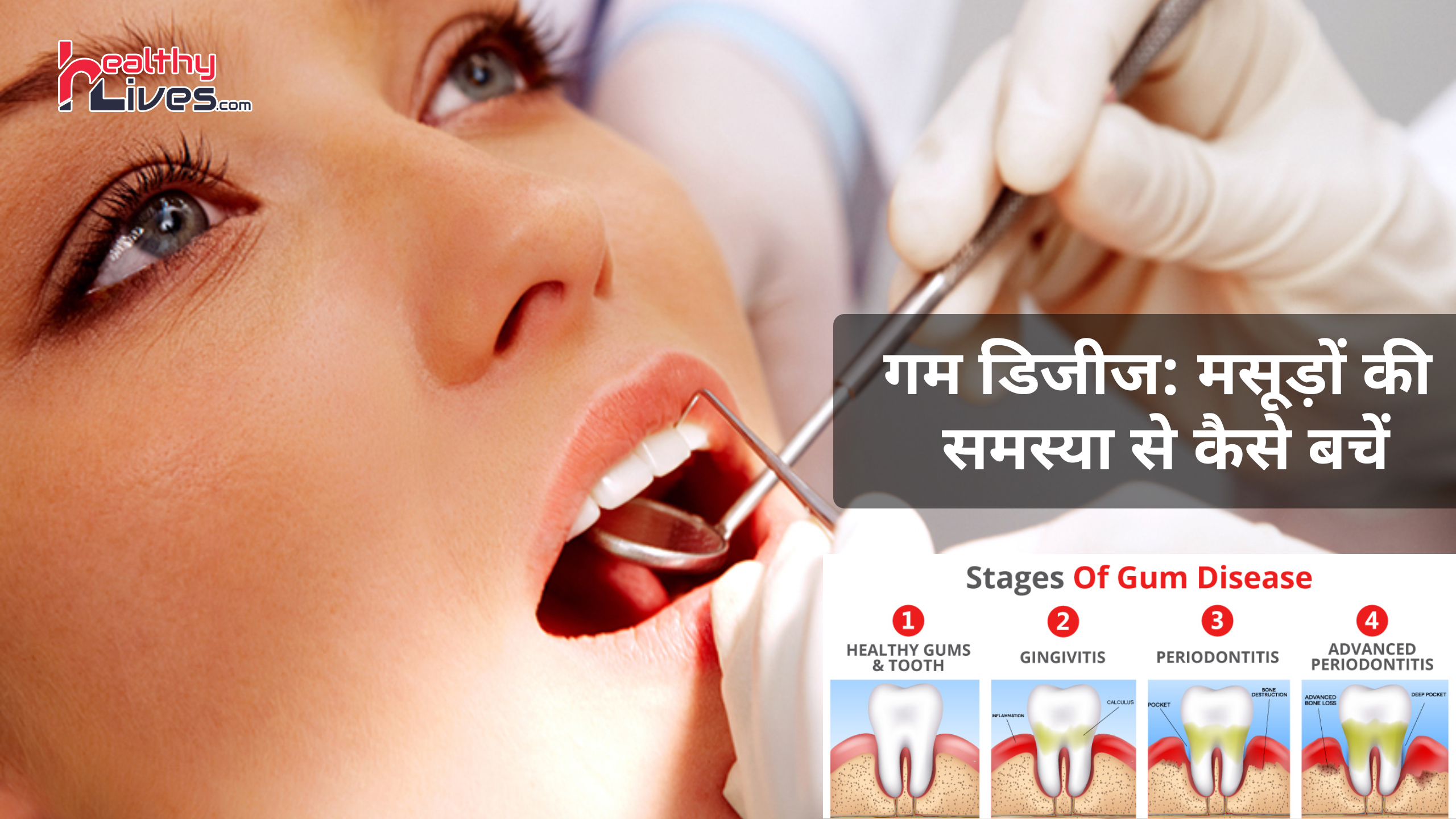 Gum Disease in Hindi: जानिए मसूड़ों की समस्याओं को कैसे कहें बाय-बाय
