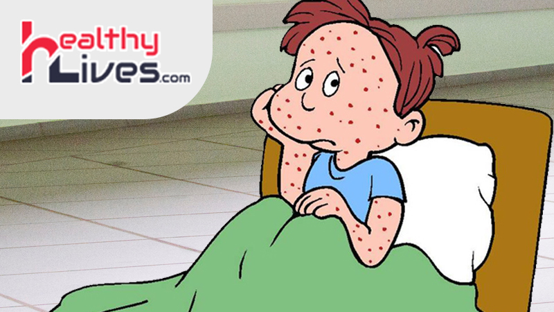 Chicken-Pox-Scar-Removal-in-Hindi