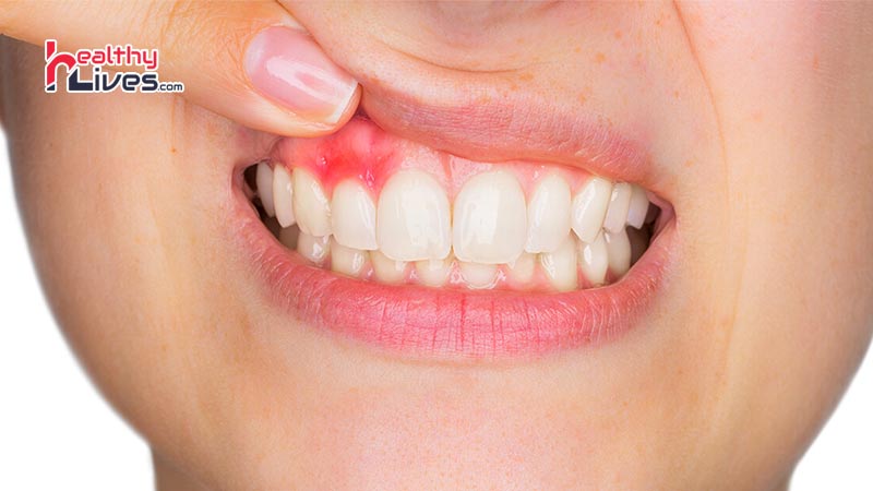 Home-Remedies-for-Gum-Pain-in-Hindi