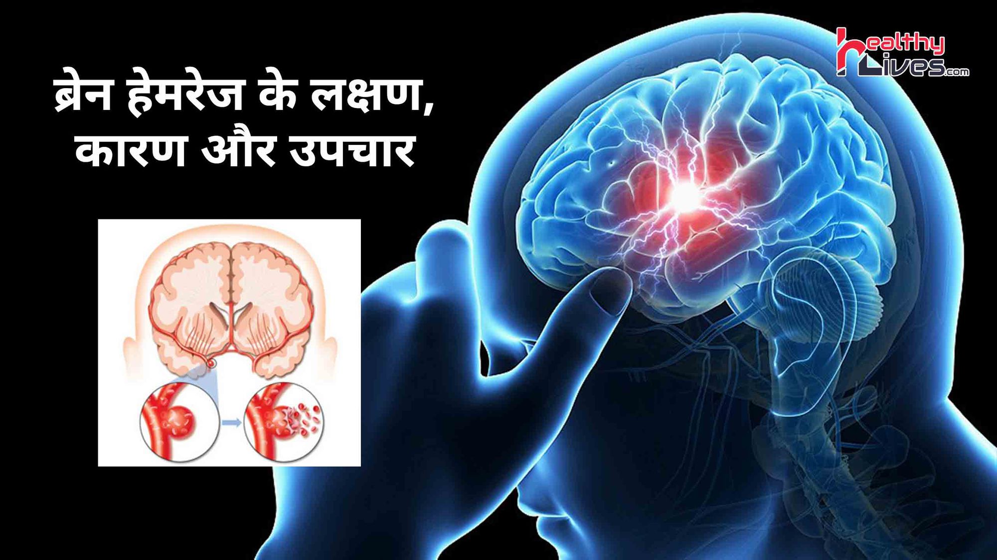 Brain Hemorrhage Ke Lakshan: ब्रेन हेमरेज के लक्षण पहचाने और खुद करे अपना बचाव